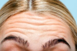 close up of forehead with wrinkles of woman 2024 11 17 12 56 43 utc